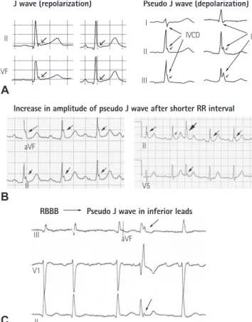 Fig. 3. Cellular basis for the traditional ER. (A) Surface ECG (lead V 5 )  recorded from a 17-year-old healthy African American man