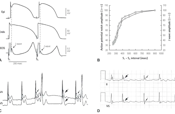Fig. 4. Frequency-dependent changes in epicardial notch and J wave amplitude. (A) Simultaneously recorded transmural ECG and transmembrane APs  from an canine right ventricular wedge: during basic stimulation (S1-S2=4000 ms) there were associated prominent