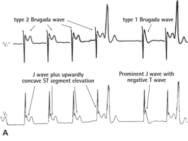 Table 4. Comparison of Brugada wave and J wave excluding V 1 -V 3