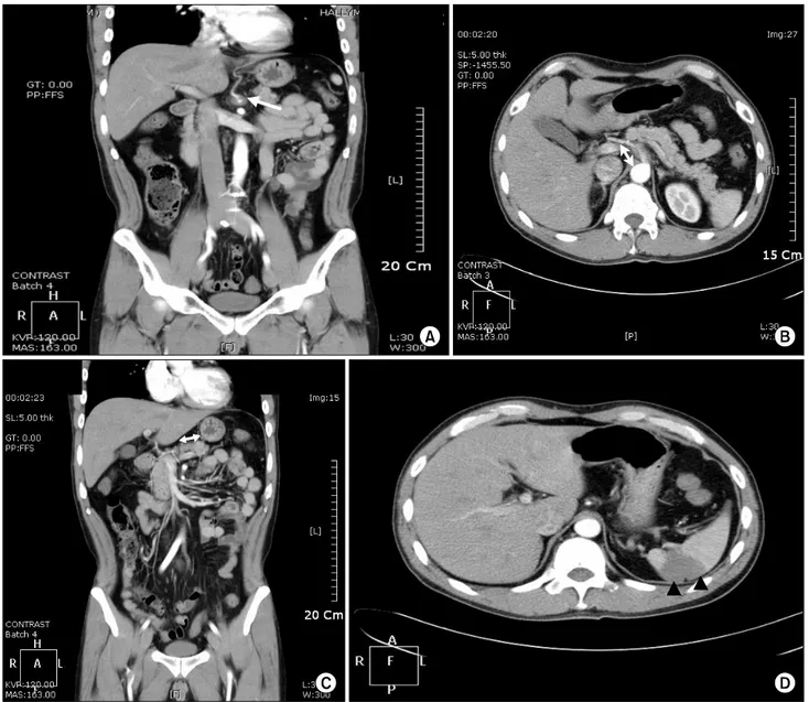 Fig.  1.  Abdomino-pelvic  CT  on  admission.  An  approximately  2.5  cm  stretch  of  low-density  and  luminal  narrowing  of  the  proximal celiac  artery  are  seen  (white  arrows  in  A  and  B)