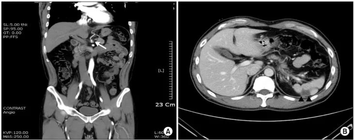 Fig.  3.  Second  follow-up  abdomino-pelvic  CT  (5  weeks  after  admission).  There  is  no  significant  interval  change  in  the  low-density dissection  with  thrombosis  at  the  origin  of  the  celiac  artery  and  splenic  artery