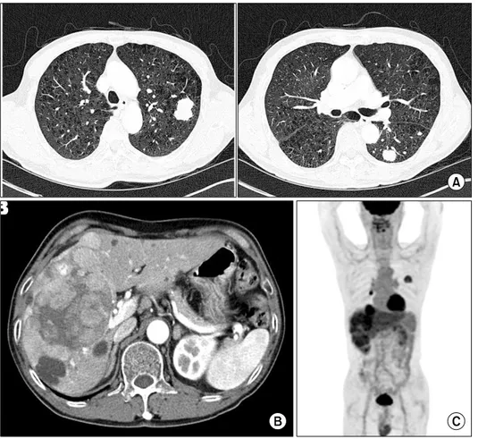 Fig.  1.  The  image  findings  at  the  initial  time  of  diagnosis.  (A)  The chest  computed  tomography  (CT) showed  multiple  nodules  which  are  suggestive  of  hematogenous  metastases  in  both  lungs