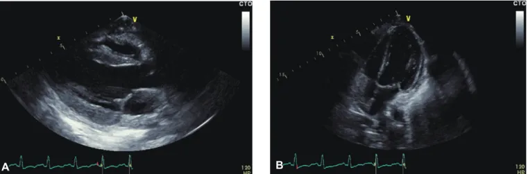 Fig. 3. Chest X-ray after pericardiocentesis, with an evident left-sided,  pleural effusion.
