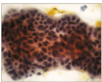Fig.  2.  Pathology  finding.  Irregular  disorganized  sheet  of  atypical  cells  from  catheter  sample  of  bile  at  PTC  (Papanicolaou 