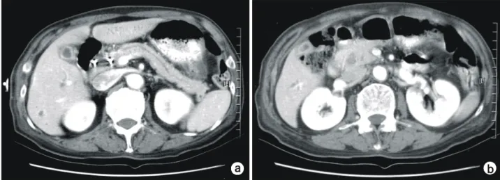 Fig.  5.  ERCP  shows  obstruction  of  common  bile  duct  with  intrahe- intrahe-patic  duct  dilatation.