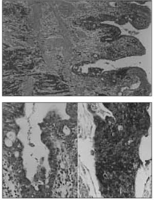 Fig. 3 Microscopic photography of resected small cell carcinoma of GB.