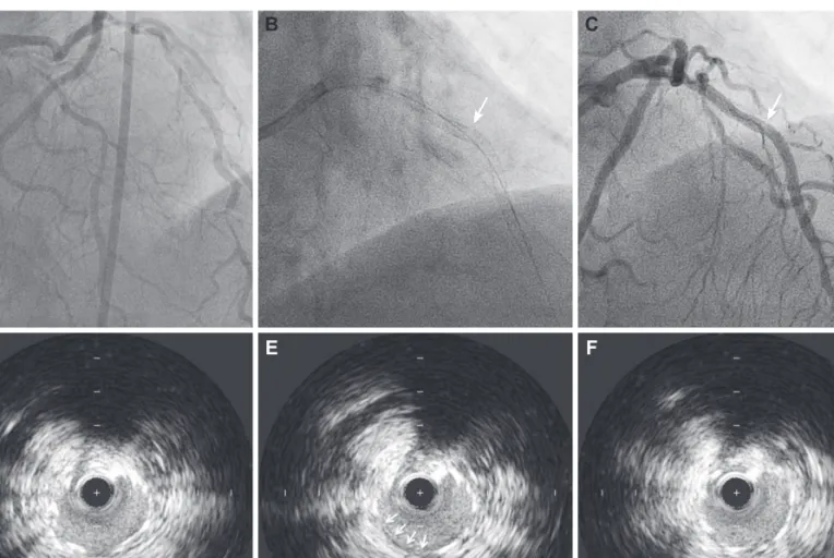 Fig. 2. Representative coronary angiographic and IVUS findings in case 2. A: AP caudal view of coronary angiogram shows diffuse eccentric stenosis from  ostium to mid-portion of left anterior descending artery