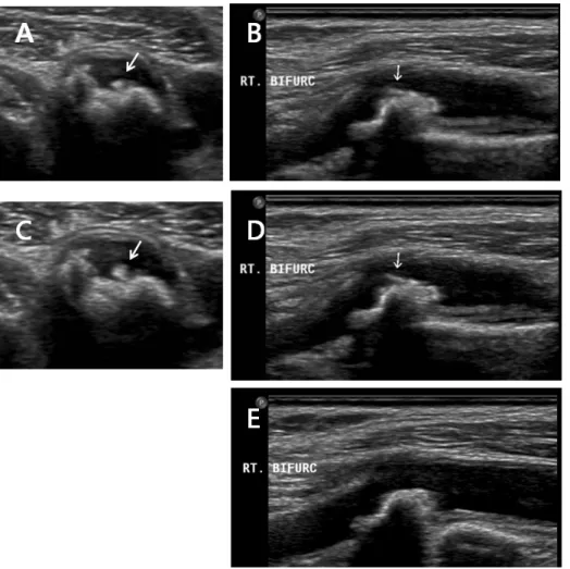 Figure  1.  Case  1  (carotid  mobile  thrombus).  (A)  B-mode  image  showed  a  mobile  thrombus  during  systole  in  transverse  view  of  right  carotid  bulb