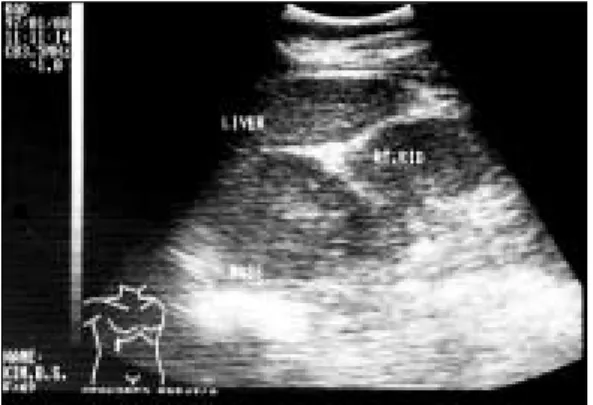 Figure 2. Preoperative computerized tomogram revealing retroperitoneal mass with extensive invasion to posterior segment and caudate lobe of liver, as well as, right kidney and adrenal