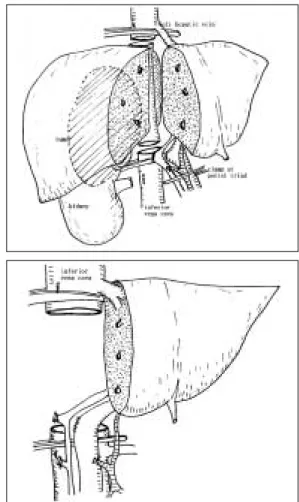 Figure 3. Schematic  illustration  showing  venov- venov-enous bypass used in present case.
