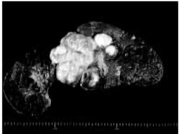 Figure 9. Computerized tomogram at three months after operation, showing regenerated liver and vivid contrast enhancement of vena cava.