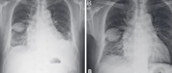 Fig. 1. Chest X-ray on the first day of hospitalization and 8 days after pericardiectomy
