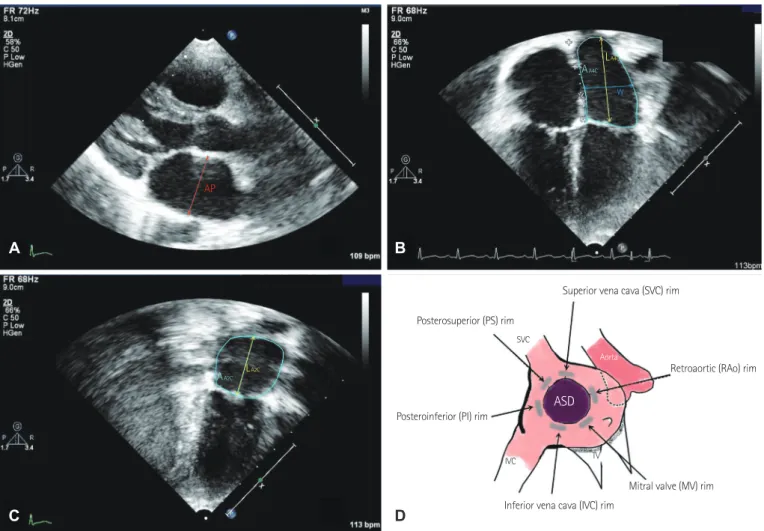 Fig. 1. Measurements of the LA diameters (A, B, C) and schematic diagram of the surrounding rims from the pre-interventional TTE (D)