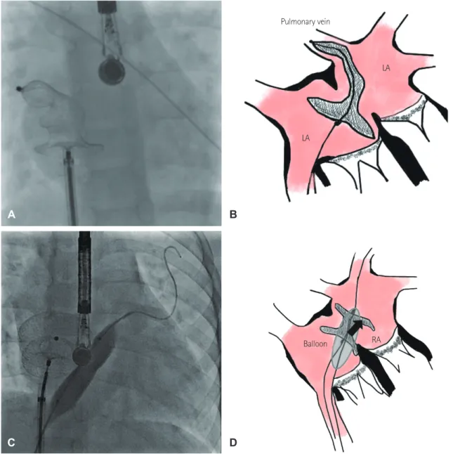 Fig. 2. Pulmonary vein method and schematic diagram. Angiographic film showed the approximation of the RA disc by pushing  the cable while the LA disc was in the orifice of the right upper PV (A)