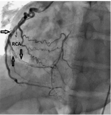 Fig. 1. Left coronary angiogram demonstrating coronary dissection in the 