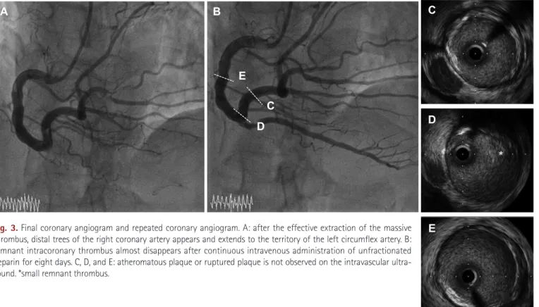 Fig. 3. Final coronary angiogram and repeated coronary angiogram. A: after the effective extraction of the massive  thrombus, distal trees of the right coronary artery appears and extends to the territory of the left circumflex artery