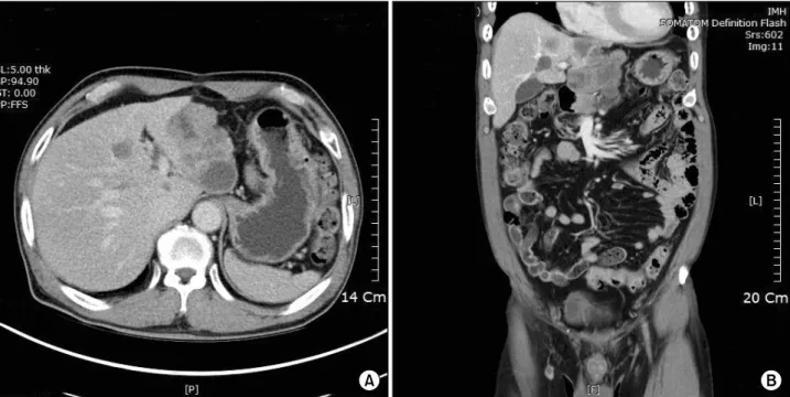 Fig.  3.  Computerized  tomography  (A)  and  (B);  the  mass  in  the  left  lobe  of  the  liver  has  progressively  increased  in  size  with another  exophytic  mass  in  the  left  lateral  section