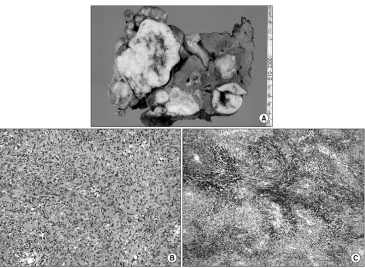 Fig.  4.  (A)  Gross  findings  of  the  specimen.  Three  masses  with  relatively  define  margins  between  the  mass  and  the  liver  parenchyme were  observed  on  the  cut  surface