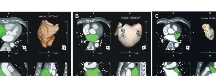 Fig. 1. Three-dimensional measurements of right atrial (A), left atrial (B), and left atrial appendage (C) volumes using software (Aquaris Intuition Edition  V4.4.6, TeraRecon, San Francisco, CA, USA) on multidetector computed tomography images
