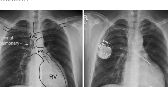Fig. 2. A schematic picture describing the one-and-a-half ventricle repair and chest X-ray image of the implanted ICD