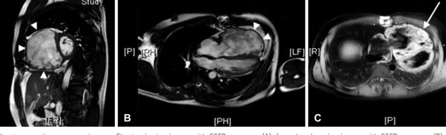 Fig. 3. Heart magnetic resonance images. Short axis cine image with SSFP sequence (A), four chamber cine image with SSFP sequence (B), delayed  enhanced image (C)
