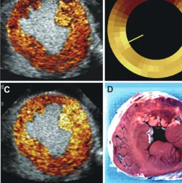 Fig. 7 is an example of a perfusion defect on MCE (Fig. 7A) that  corresponds in size to that using radiolabeled microspheres, which  is the gold standard for quantification of nutrient blood flow (Fig