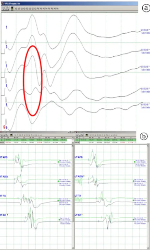Figure  4.  Continuous  direct  cortical  stimulation  observed  in  the  abductor  digiti  quinti  muscle  (a)  and  trapezius  muscle  (b)  for  the  compound  muscle  action  potentials.