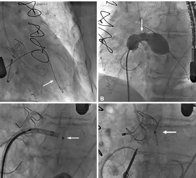 Fig. 2. Placement of Percutaneous Amplatzer Muscular ventricular septal defect (VSD) occluder