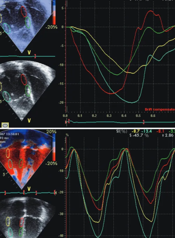 Fig. 6. Tissue Doppler strain imaging showing systemic right ventricular dyssynchrony in a patient after atrial switch operation for transposition of the  great arteries as evidenced by differences of time to peak systolic strain right ventricular free wal