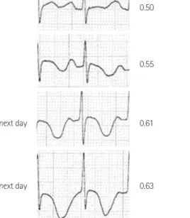Fig. 4. The changes of QTc intervals in the Holter ECG. The QTc interval was  gradually prolonged during the Holter ECG monitoring