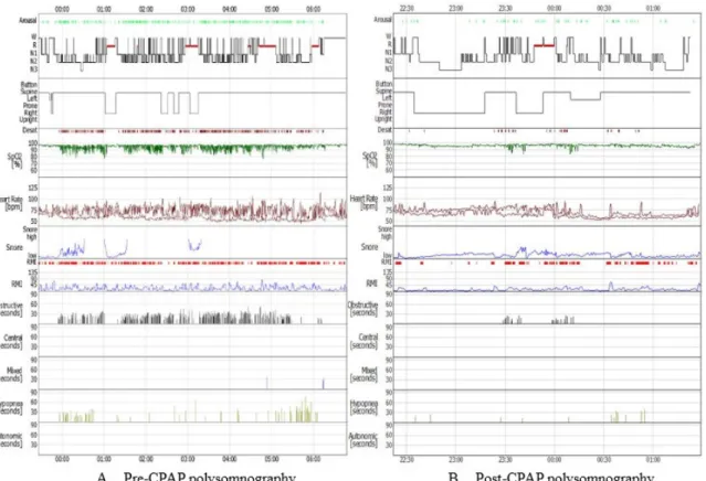 Figure  1.  The  comparison  of  pre-  and  post-CPAP  on  hypnogram. 95th Percentile: 7.7 cmH 2 O, 최대 압력: 8.8cmH 2 O이었고,  무호흡-저호흡 지수는 0.8로 관찰되었다