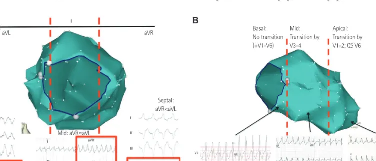 Fig. 2. Localization of VT exit site using surface ECG. A: for VTs of septal origin, aVR is typically <aVL, while for lateral VTs the opposite is true