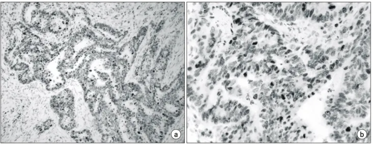 Fig.  1.  Immunohistochemical  analysis  of  Ki-67,  showing  nuclear  staining  of  the  neoplastic  cell  of  a  tumor  with  high  proliferation  index