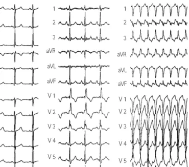 Fig. 1. 12-lead surface electrocardiograms. (A) shows the baseline normal  sinus rhythm