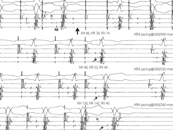 Fig. 4. Burst pacing and programmed stimulation from HRA. The top panel shows that burst pacing from the HRA at 280 msec prolonged the interval be- be-tween the His and RB, and resulted in intra/infra Hisian block (big arrow; Wenckebach block)