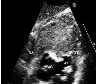 Fig. 2. High flow acceleration around the aneurysm demonstrated that  right ventricular outflow tract had been obstructed by it