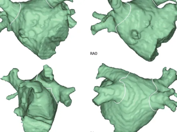 Fig. 9. Designed ablation line on the merged 3-dimensional left atrium. AP: anteroposterior projection, RAO: right anterior oblique projection, PA: postero- postero-anterior projection, LAO: left postero-anterior oblique projection.