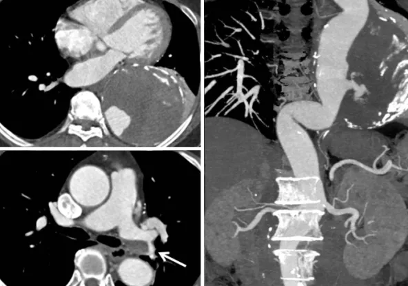 Fig. 1. Pre-procedural aorta CT of presented patient. A: axial CT image shows the huge aneurysm (11 cm of diameter) containing the thrombus