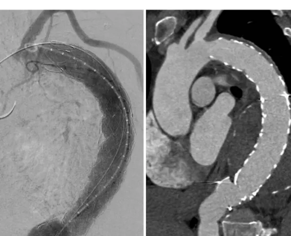 Fig. 4. A pig-tail aortogram and CT angiography after stent-graft insertion. A: a aortogram shows the good position of stent-graft without any kind of  leakage