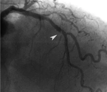 Fig. 1. A severe lesion in the middle portion of the left anterior descendent 