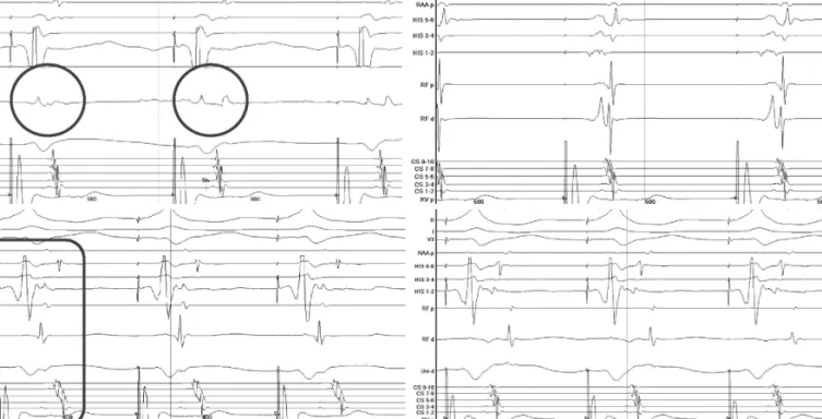Fig. 3. The left upper panel shows change of the retrograde activation pattern during energy delivery with a shift from the right anterior septal pathway  (circle) to the right postero-septal pathway (circle)