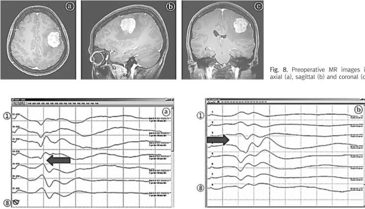 Fig.  8.  Preoperative  MR  images  in  axial  (a),  sagittal  (b)  and  coronal  (c).