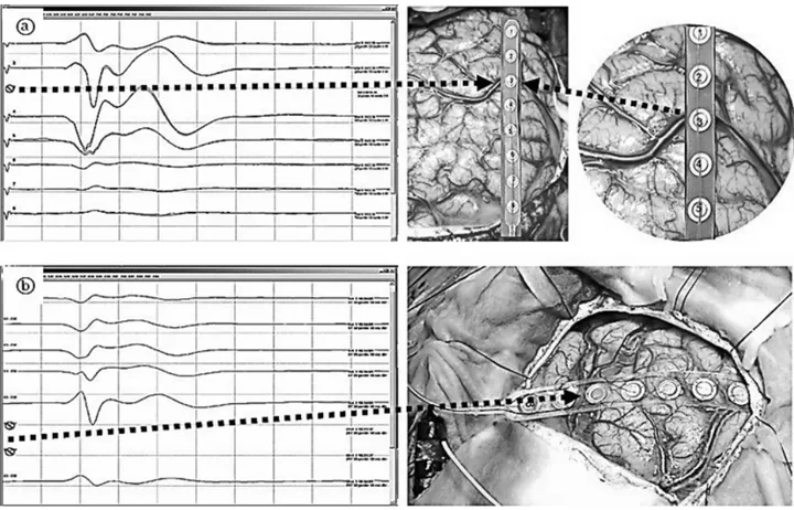 Fig.  13.  Illustrated  intraoperative  SEP  recording  on  the  vessel  ((a)  trace  3,  (b)  trace  6,7  are  no  response).