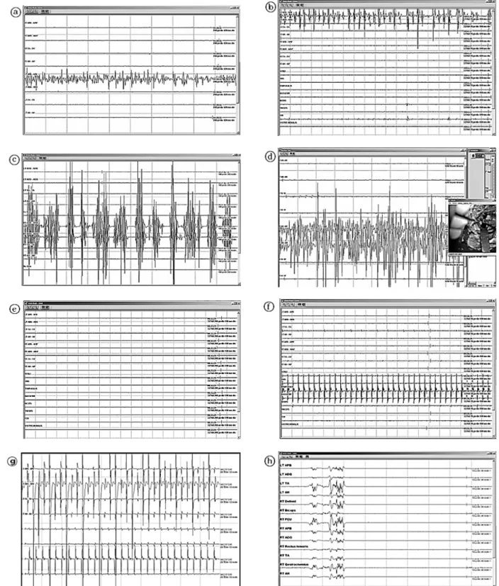 Fig.  18.  Intraoperative  DCS  recording  (a,  b,  c,  d),  Waveform  when  it  is  not  stimulated  (e),  It  is  given  stimulation,  waveform  when  I  took  off  lightly  the  probe  of  the  brain  cortex  (f,  g,  h).