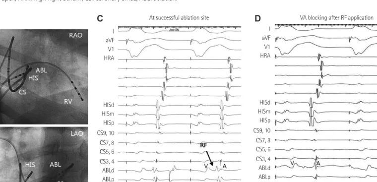 Fig. 2. Ablation of resistant left lateral accessory pathway via the intracoronary sinus approach
