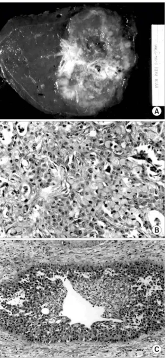 Fig.  2.  (A)  Cut  surface  of  the  right  hepatectomy  specimen  showing  an  ill-defined  pinkish  yellowish  white  necrotic  tumor  mass  with  fibrous  septae  measuring  10×7  cm  in  size