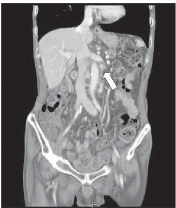 Fig. 6. CT scan of 11months after surgery, we noted progression  of  multiple  LN  recurrent  metastasis  of  the  paraaortic  and  mesenteric nodes.(white arrow).
