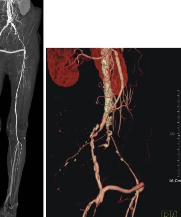 Fig. 1. Computerized tomography angiography revealed a patent graft, but  also a high-grade irregular stenosis of the right common iliac artery and a 