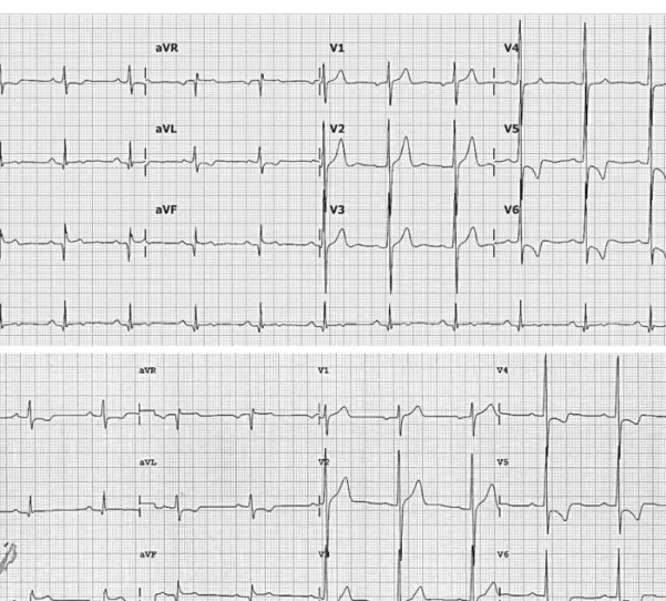 Fig. 2. Electrocardiography before (A) and after (B) revascularization.