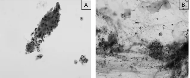 Fig.  3.  Results  of  papanicolaou’s  staining  for  liquid-based  cytology  (A,  ×200)  and  conventional  smear  (B,  ×200)  in  same  squamous cell  carcinoma  cases